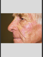 After Photo Vbeam Laser Treatment of Port Wine Stain - Prejuvenation Before & After