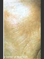 After Photo Treatment of Facial Pigmentation - Prejuvenation Before & After