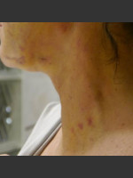 After Photo Treatment of Neck Brusing - Prejuvenation Before & After