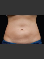 After Photo Dr. Langdon CoolSculpting - Prejuvenation Before & After