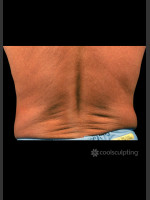 Before Photo CoolSculpting on Man Flanks (Love Handles) - Prejuvenation Before & After