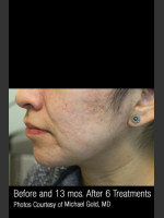 After Photo #301 - Treatment of Cystic Acne - Prejuvenation Before & After