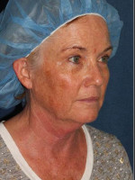 Before Photo Chin Contouring & Sun Damage Treatment - Prejuvenation Before & After