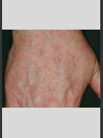 After Photo Vbeam Laser Treatment of Pigmentation - Prejuvenation Before & After