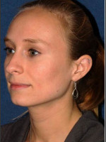 After Photo Facial Acne Treatment - Prejuvenation Before & After