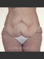 Before Photo Circumferential Body Lift 367 - Prejuvenation Before & After