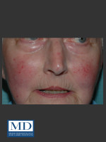 Before Photo Rosacea Treatment 101 - Prejuvenation Before & After