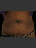 After Photo Body Contouring Treatment #115 - Prejuvenation Before & After
