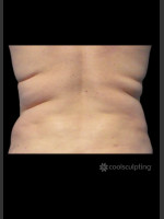 Before Photo CoolSculpting on Woman's Love Handles - Prejuvenation Before & After