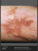 Before Photo Scar Reduction Using Icon 1540 - Prejuvenation Before & After