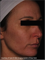 After Photo Facial Skin Rejuvenation with Clear and Brillant Permea - Prejuvenation Before & After