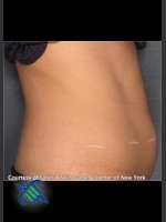 Before Photo Treatment of Lower Abdomen Right Side - Prejuvenation Before & After