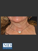 Before Photo Neurotoxin of Neck 132 - Prejuvenation Before & After