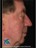 After Photo Male Full Face Fraxel Treament - Prejuvenation Before & After