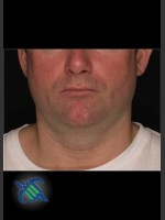 Before Photo Treatment of Male Neck with Laser Liposuction - Prejuvenation Before & After