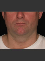 Before Photo Treatment of Neck with Laser Liposuction - Prejuvenation Before & After
