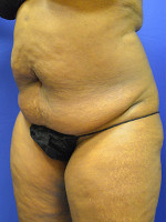 Before Photo Tummy Tuck Case #1 - Prejuvenation Before & After