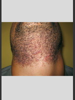 Before Photo Gentle Laser Hair Removal of Beard Bumps - Prejuvenation Before & After
