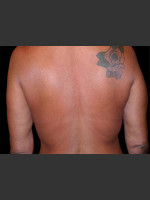 After Photo Body Contouring Treatment #113 - Prejuvenation Before & After