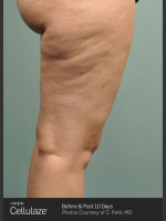 Before Photo Cellulaze Cellulite Treatment of the Thighs - Prejuvenation Before & After