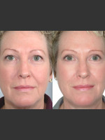 Before Photo Two women with Laser Eyelid Blepharoplasty - Prejuvenation Before & After