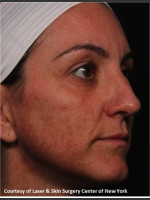 Before Photo Full face Treament with Fraxel - Prejuvenation Before & After