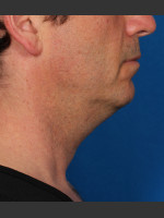 Before Photo Kybella Treatment 47 Year Old Male - Prejuvenation Before & After