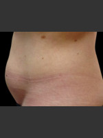 Before Photo Body Contouring Treatment #117 - Prejuvenation Before & After