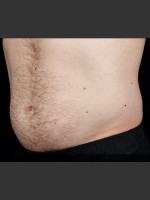 After Photo SculpSure Abdomen - Prejuvenation Before & After