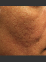 Before Photo Infini Acne Scar Treatment #12 - Prejuvenation Before & After