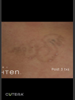 After Photo Tattoo Removal of Snake - Prejuvenation Before & After
