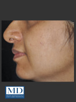 After Photo Post Inflammatory Hyperpigmentation 120 - Prejuvenation Before & After