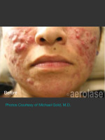 Before Photo NeoClear by Aerolase Acne Treatment - Prejuvenation Before & After