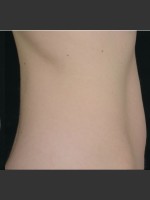 After Photo SculpSure Abdomen - Prejuvenation Before & After