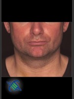 After Photo Treatment of Male Neck with Laser Liposuction - Prejuvenation Before & After