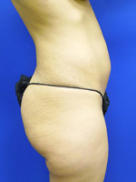 Before Photo Brazilian Butt Lift Case #1 - Prejuvenation Before & After