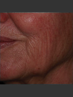 Before Photo Infini Rhytides Treatment #19 - Prejuvenation Before & After