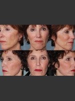 After Photo Single treatment of fully ablative  Laser Resurfacing - Prejuvenation Before & After