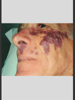 Before Photo Vbeam Laser Treatment of Port Wine Stain - Prejuvenation Before & After