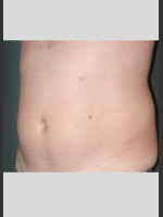 After Photo UltraShape Body Contouring Abdomen - Prejuvenation Before & After
