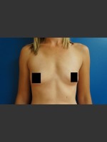 Before Photo Breast Augmentation - Prejuvenation Before & After