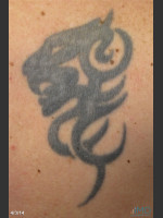 Before Photo Picosure Laser Tattoo Removal of Lion - Prejuvenation Before & After