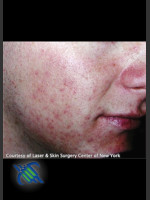 Before Photo Treatment of Facial  Acne Scars - Prejuvenation Before & After