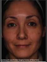 After Photo Treatment of Melasma - Prejuvenation Before & After