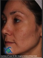 After Photo Pigment Facial Skin Rejuvenation - Prejuvenation Before & After