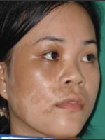 Before Photo Quanta MDK Treatment of Pigment #78 - Prejuvenation Before & After