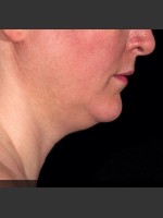 After Photo SculpSure Submental - Prejuvenation Before & After