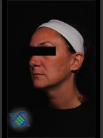 Before Photo Treatment of Facial Melasma - Prejuvenation Before & After
