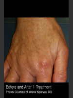After Photo Treatment of Pigmentation #329 - Prejuvenation Before & After