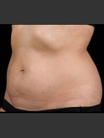 After Photo SculpSure Abdomen - Prejuvenation Before & After